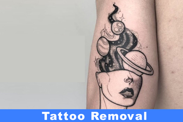 Tattoo Removal
